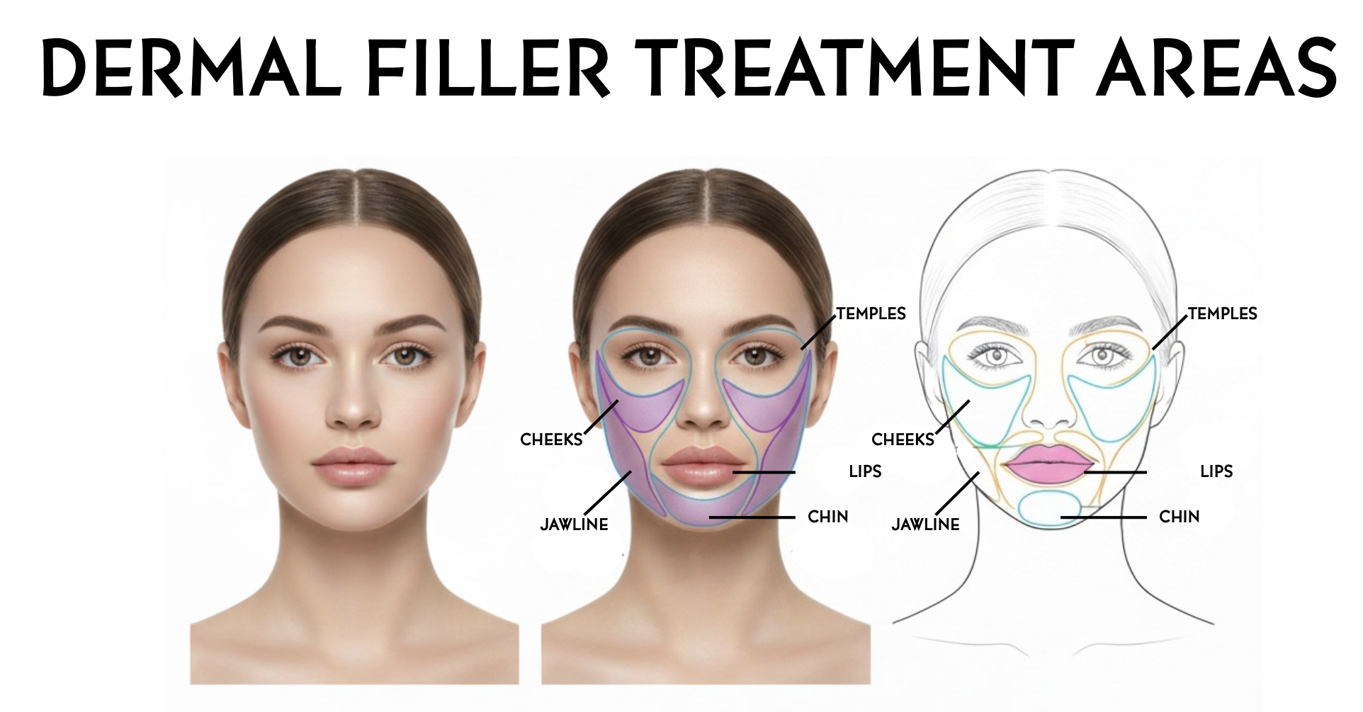 Dermal Filler Treatment areas from Restorative health of Colorado