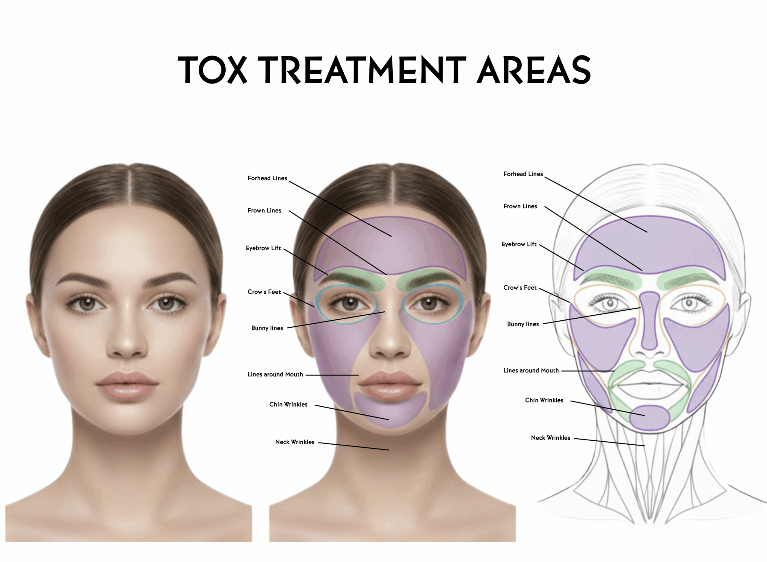 Botox Treatment areas from Restorative Health of Colorado
